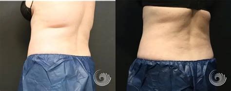 Coolsculpting Elite Reducing Fat On Her Flank Before And After