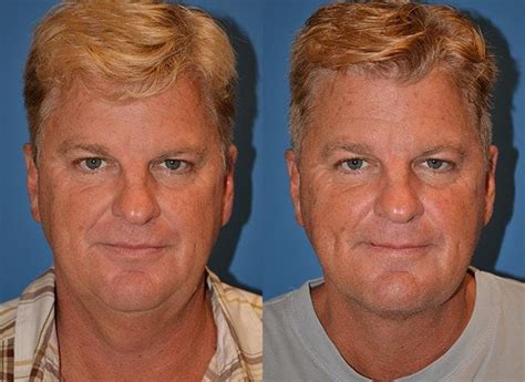 Laser Assisted Weekend Neck Lift In Central Florida