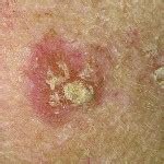Scaly Skin Patches Causes Symptoms Treatment Pictures Healthmd