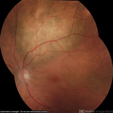 Regressed Choroidal Metastasis Retina Image Bank
