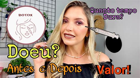 Fiz BOTOX Pela Primeira Vez Tudo Sobre Meu Botox Valores Se Doeu Onde Fiz Quanto Tempo