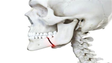 How Long Does A Fractured Jaw Take To Heal