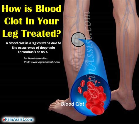 Early Blood Clot Symptoms Know The Risks Signs Symptoms Of Blood