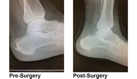 For The Heel Of It Haglunds Deformity Advanced Orthopaedic