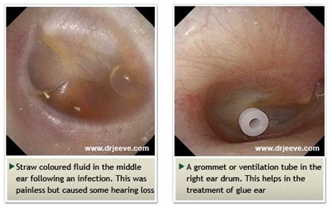 The inner ear is responsible for hearing and balance. 49 best Ear Infections images on Pinterest | Middle ear ...