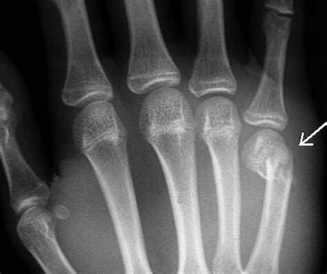 Boxer Fracture Radiograph Shows A Fracture Of The Fifth Metacarpal