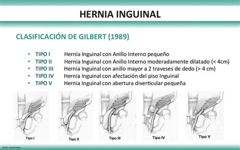 Hernias Pared Abdominal 2017 Hernia Inguinalhernia Femoral
