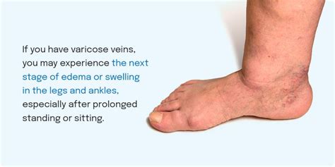 The Stages Of Vein Disease Texas Vein And Wellness Institute