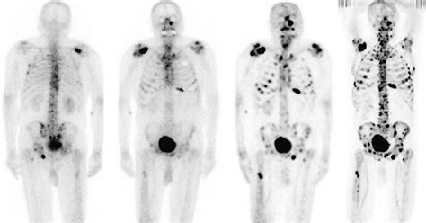 The Detection Of Bone Metastases In Patients With High Risk Prostate