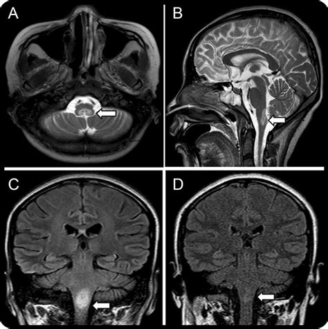 A B T Weighted Axial And Sagittal Images Reveal Focal Hyperintensity Within The Dorsal