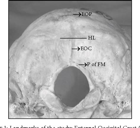 Figure 1 From Occipital Emissary Foramina In South Indian Modern Human