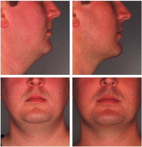 Chin Reduction Kybella Before And After Beverly Hills Weho Ca
