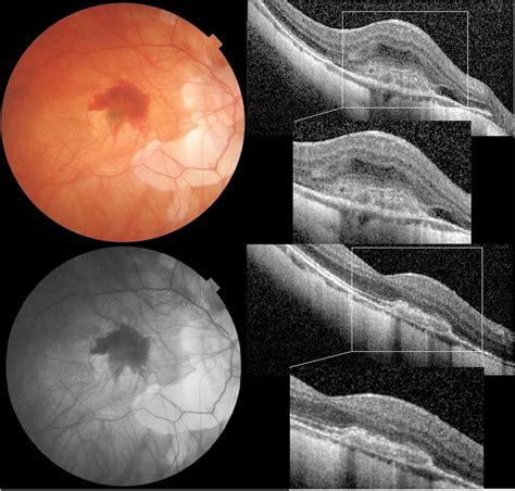 Baseline And Final Oct Color Fundus And Fundus Autofluorescence Faf