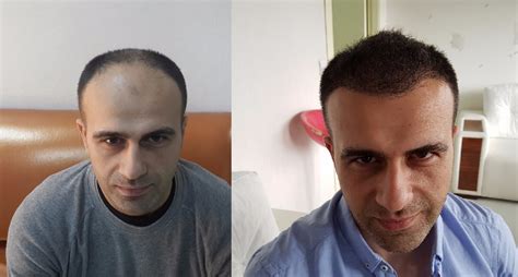 Hair Transplant Prices And Service In Turkey OrcaFree Org