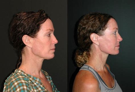Deep Plane Facelift Before And After Photo Dr Jacono In 2022 Plastic