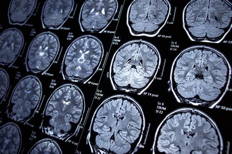 New Brain Scanning Technique For Detecting Concussions Slater Vecchio Llp