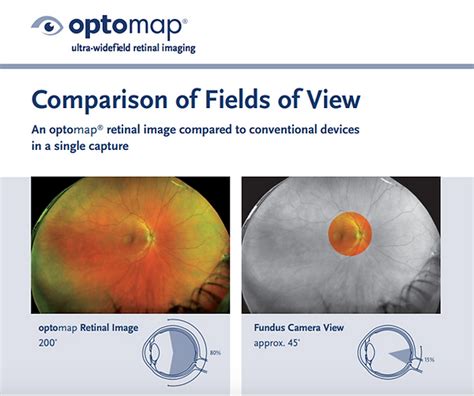 Optomap Eye Examinations Retinal Scans At Oakwood Eyecare