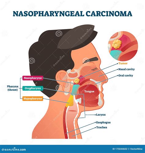 Nasopharynx Cancer Nasal Cavity Nose Diagram Nose Transparent Images