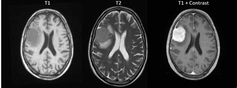 The timing of radiofrequency pulse sequences used to make t1 images results in images which highlight. The Basics of MRI Interpretation | Radiology | Geeky Medics