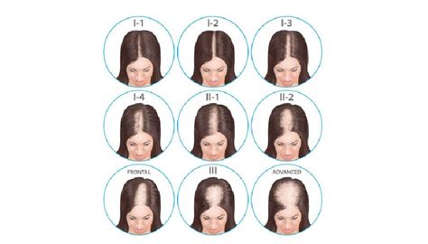 ¿qué Es La Alopecia Tipos De Alopecia Y Grados Face Clinic