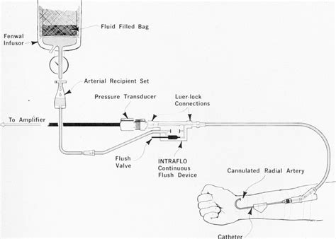 Percutaneous Indwelling Radial Artery Catheters For Monitoring
