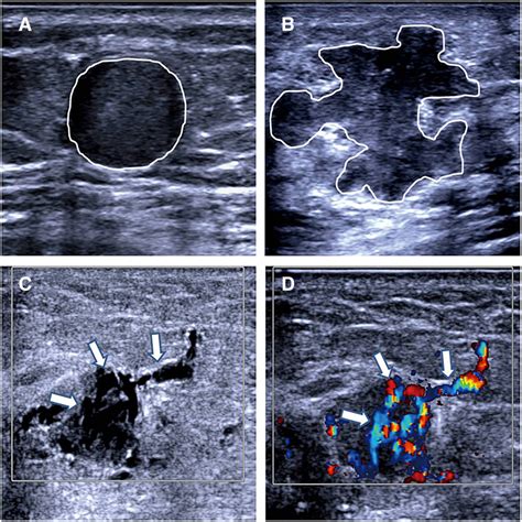 Ultrasound Features Of Breast Cancer For Predicting Axillary Lymph Node