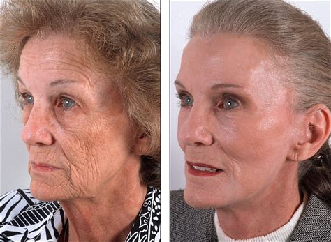 Dr Steven Denenbergs Facial Plastic Surgery Before And Afters Skin