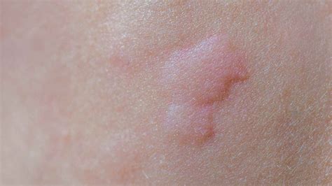 Hives Vs Rash How To Tell The Difference Dermeleve®