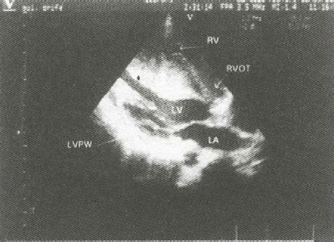 Echocardiographic Pre Operative View Of Asymmetric Septal Hypertrophy