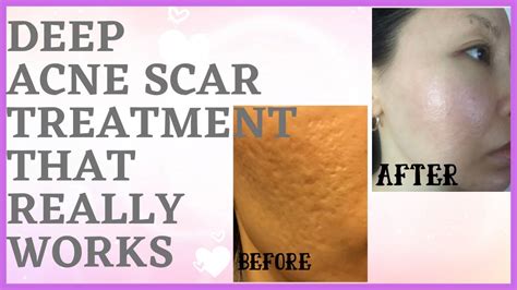 Deep Acne Scar Treatment Part 1 Yujins Real Acne Scar