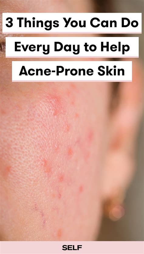 3 Things You Can Do Every Day To Get Clearer Skin Skin Care Acne