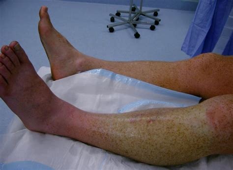 compartment syndrome pictures treatment causes surgery hubpages