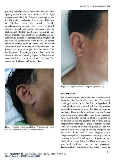 Transient Unilateral Parotid Gland Swelling Following Upper Endoscopy