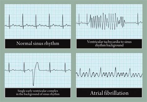 10 signs and symptoms of arrhythmia rm healthy