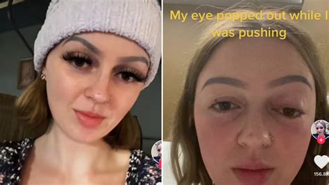 Woman Pushes So Hard During Birth Her Eye Starts Swelling Herie