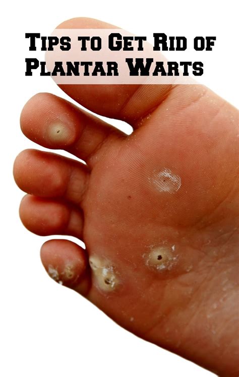 Tips To Get Rid Of Plantar Warts Get Rid Of Warts Home Remedies For