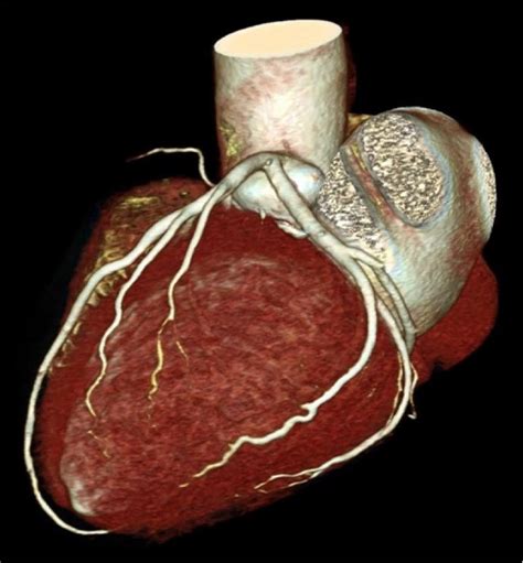 Ct Coronary Angiogram Cardiology Tasmania