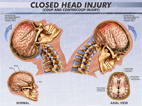 Closed Head Injury Lateral Order