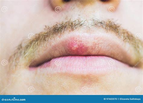 Virus Herpes Infected On Male Lip Closeup Stock Photo Image Of