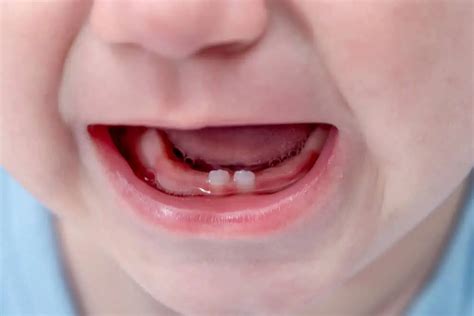 Baby Teeth Guide What To Expect Milk Teeth Care And Problems