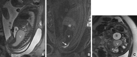 Imperforated Hymen In A Female Fetus Sagittal T2 W A And T1 W B