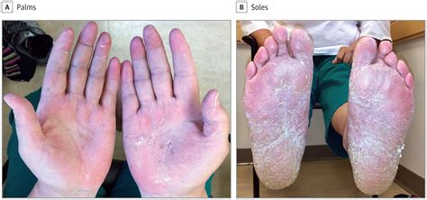 Topical Crisaborole—a Potential Treatment For Recalcitrant Palmoplantar