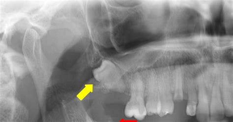 Te Vejo Por Dentro Dente 18 Decolando E Fragmento Radicular Do Dente 48