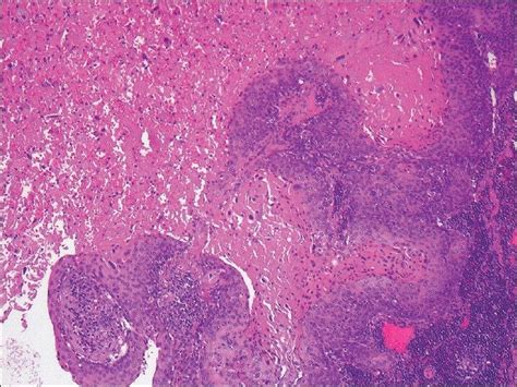 Metastatic Squamous Cell Carcinoma Pictures Photos