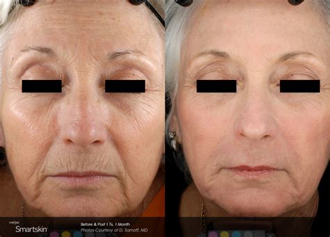 Smartskin® Laser Skin Resurfacing Slo Coastal Derm And Aesthetics