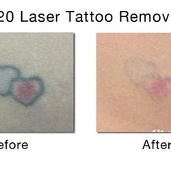We did not find results for: Disappearing Ink - Laser Tattoo Removal - Tattoo Removal ...