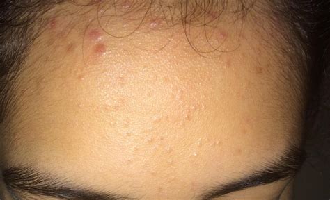 Hairline Acne What Is It And How Do You Get Rid Of It R