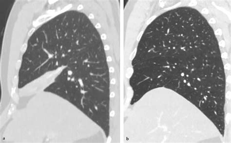 4 Lungs Radiology Key