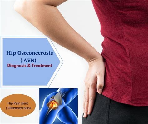 Hip Osteonecrosisavn Diagnosis And Treatment The Prolotherapy