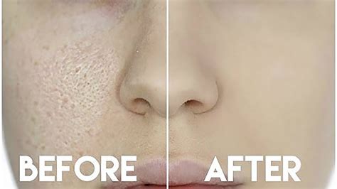 How To Fix Enlarged Skin Pores Trend 4 Girls Find The Unique Look